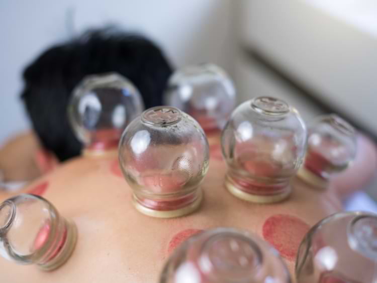 cupping en verre 