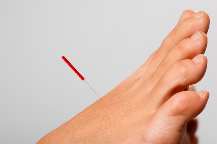 acupuncture pied avec aiguille fine