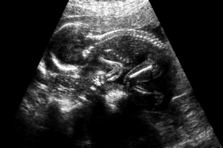 échographie du foetus